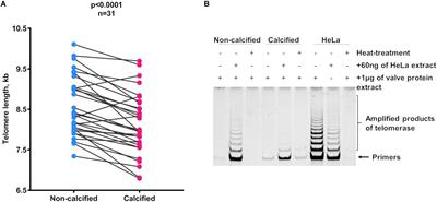 Telomere Length in Valve Tissue Is Shorter in Individuals With Aortic Stenosis and in Calcified Valve Areas